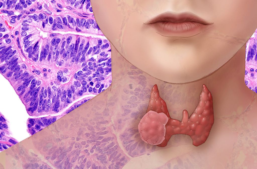 Confronting Thyroid Problems Perspectives on Conventional